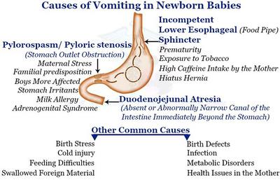 Causes of Vomiting in Newborn Babies