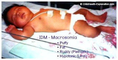 Macrosomia: Large For Gestational Age Baby