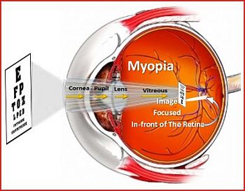 Myopia: Image is Focused In-front of Retina