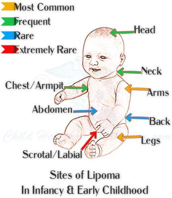 Lipoblastoma: The Infantile Lipoma