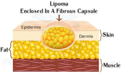 Lipoma: Growing Lump of Fat Under The Skin